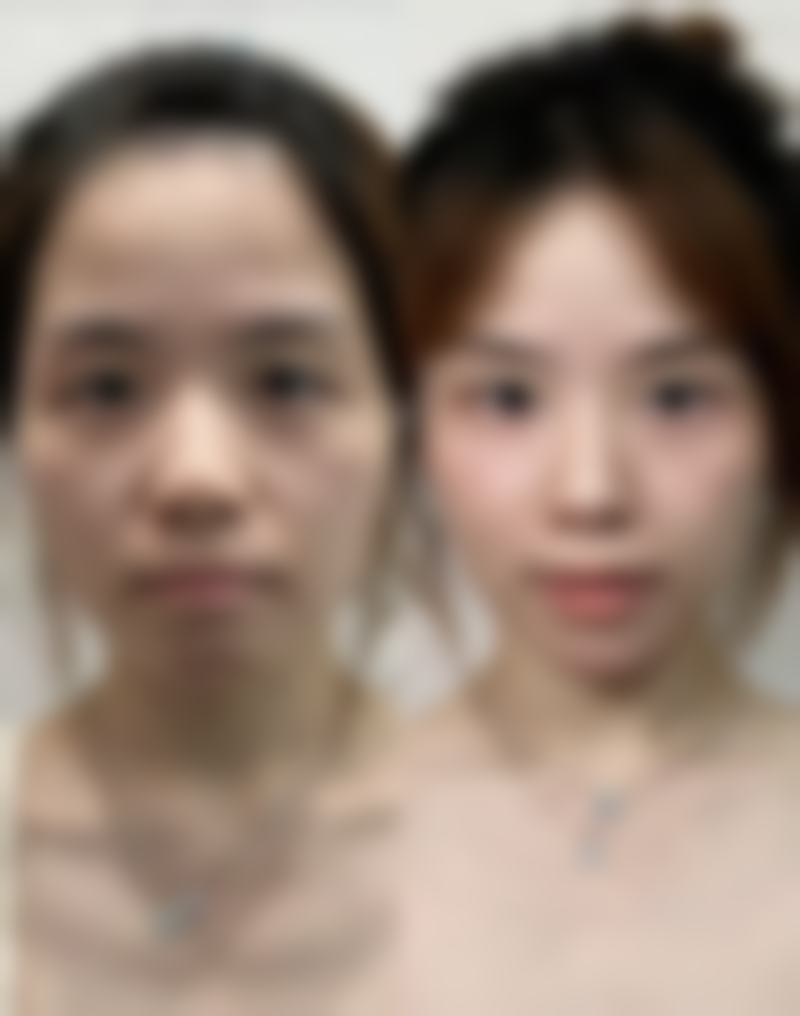 三、副乳吸脂手术修复的具体阶段