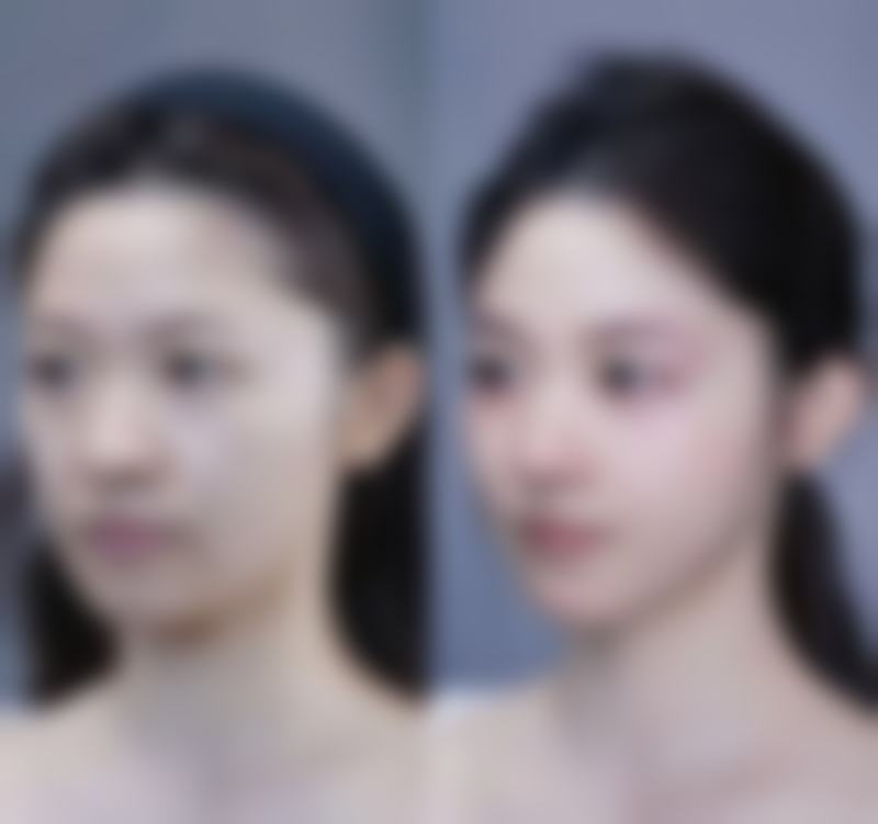 二、隆鼻鼻子歪了的解决方法