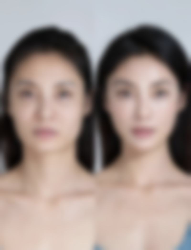 五、割双眼皮手术的风险和注意事项