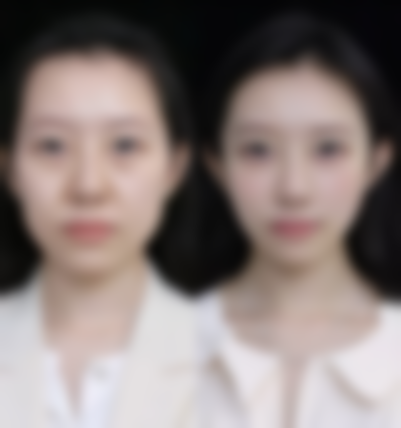 一、打瘦脸针的基本原理