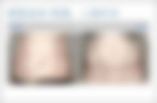 六、种植头发真的不会掉吗?真实实例分享