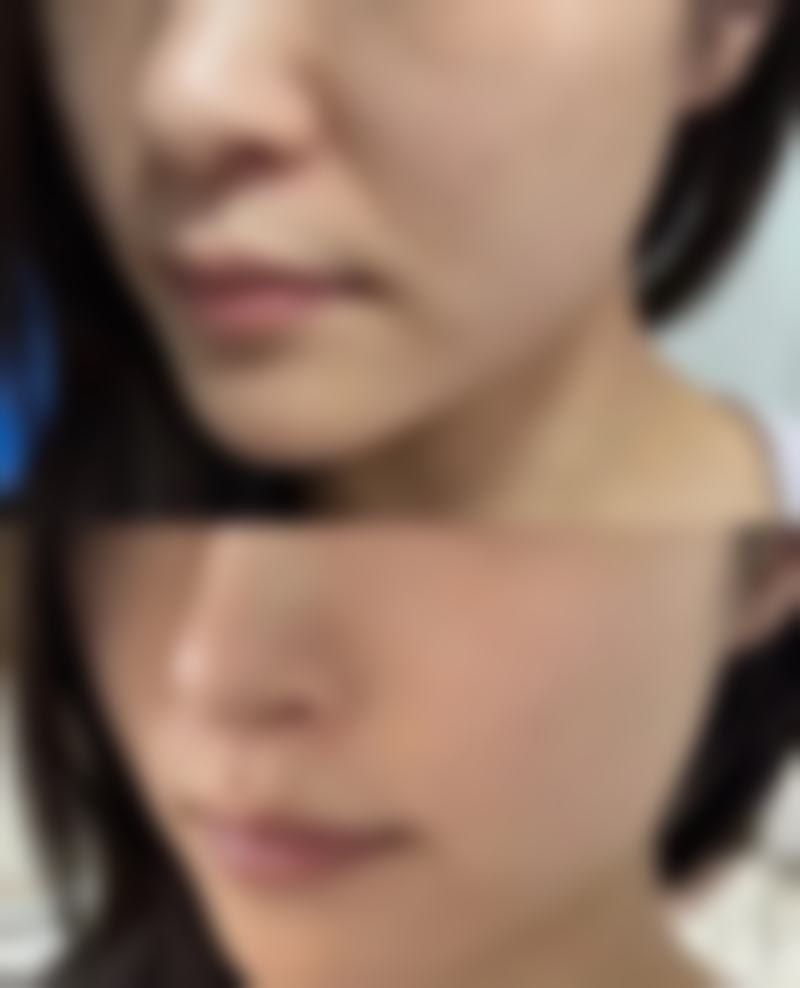 五、后变的双眼皮是什么基因型?研究现状与展望