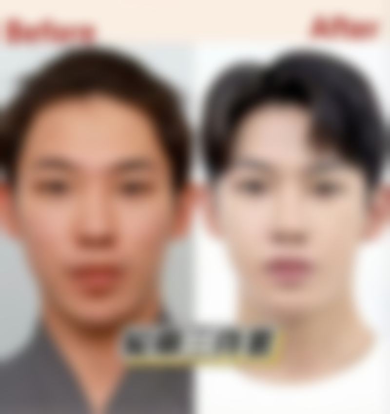 三、影响自体肋骨隆鼻多年后移位的因素