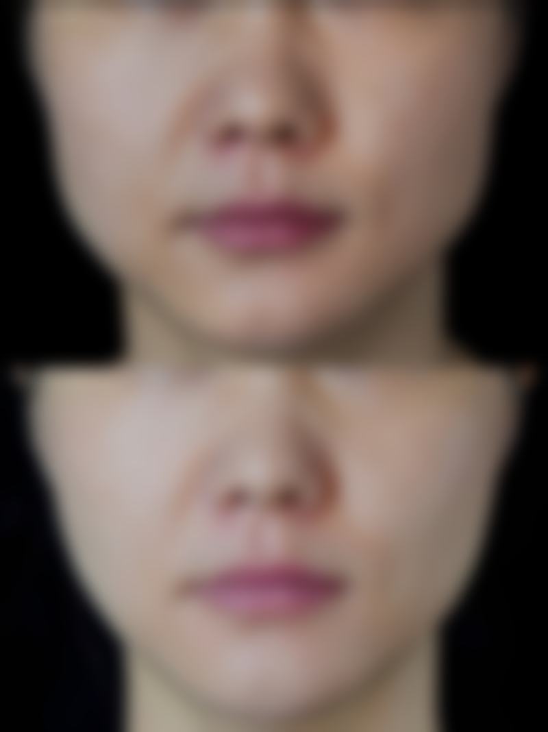 二、自体肋骨隆鼻多年后会移位吗