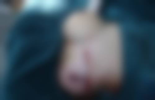 五、修复额头的凹疤痕之切除缝合术
