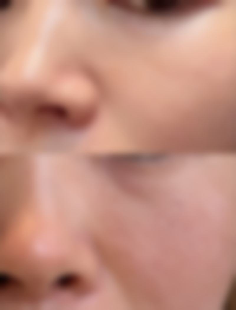 一、额头的凹疤痕成因及影响