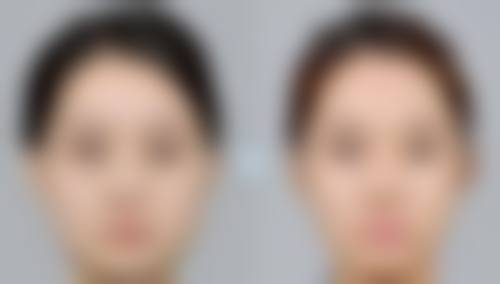 二、改善双眼皮成内双的非手术方法