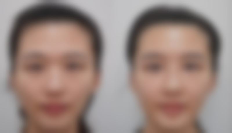 五、手术风险和术后护理的区别