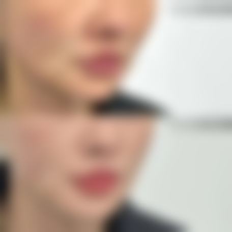 三、硅胶隆鼻取出后的修复注意事项