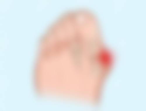 四、植发后的注意事项