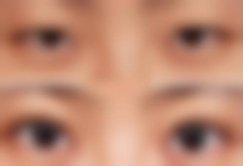十几年凹陷性疤痕怎么修复好？激光与手术治疗为你提供有效改善方案 