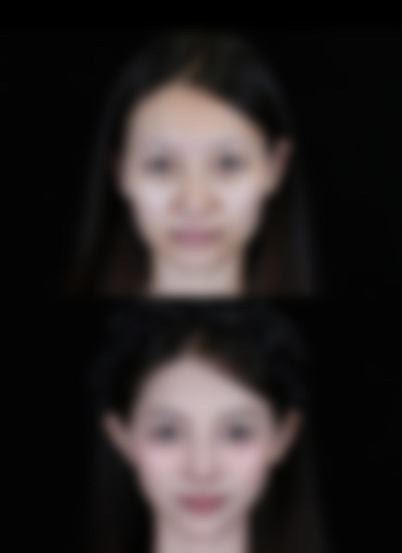 二、作息因素引发的眼袋黑眼圈好重