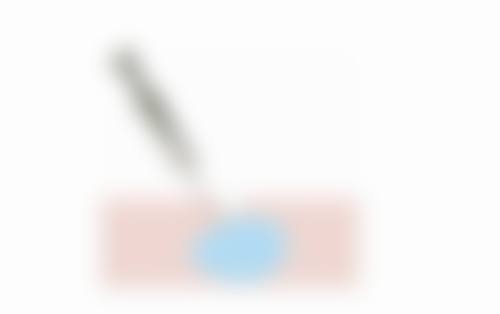 二、个人体质对隆鼻一般需要多少天修复的影响