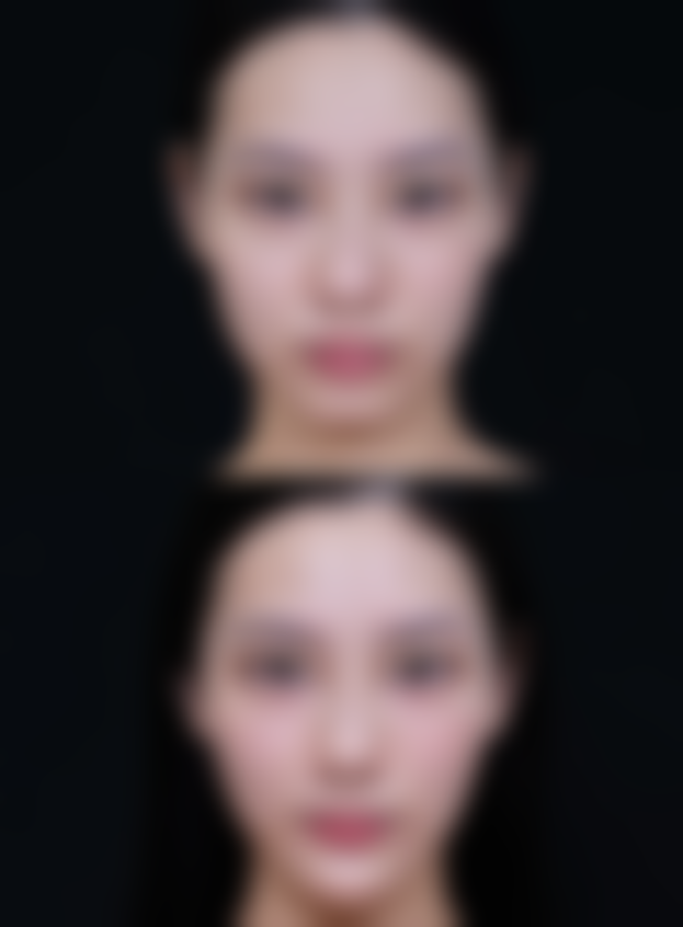 五、隆鼻修复的不同阶段