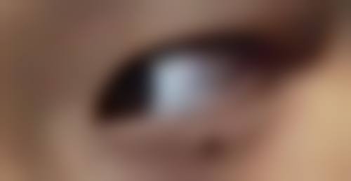 五、影响隆鼻修复时间的因素