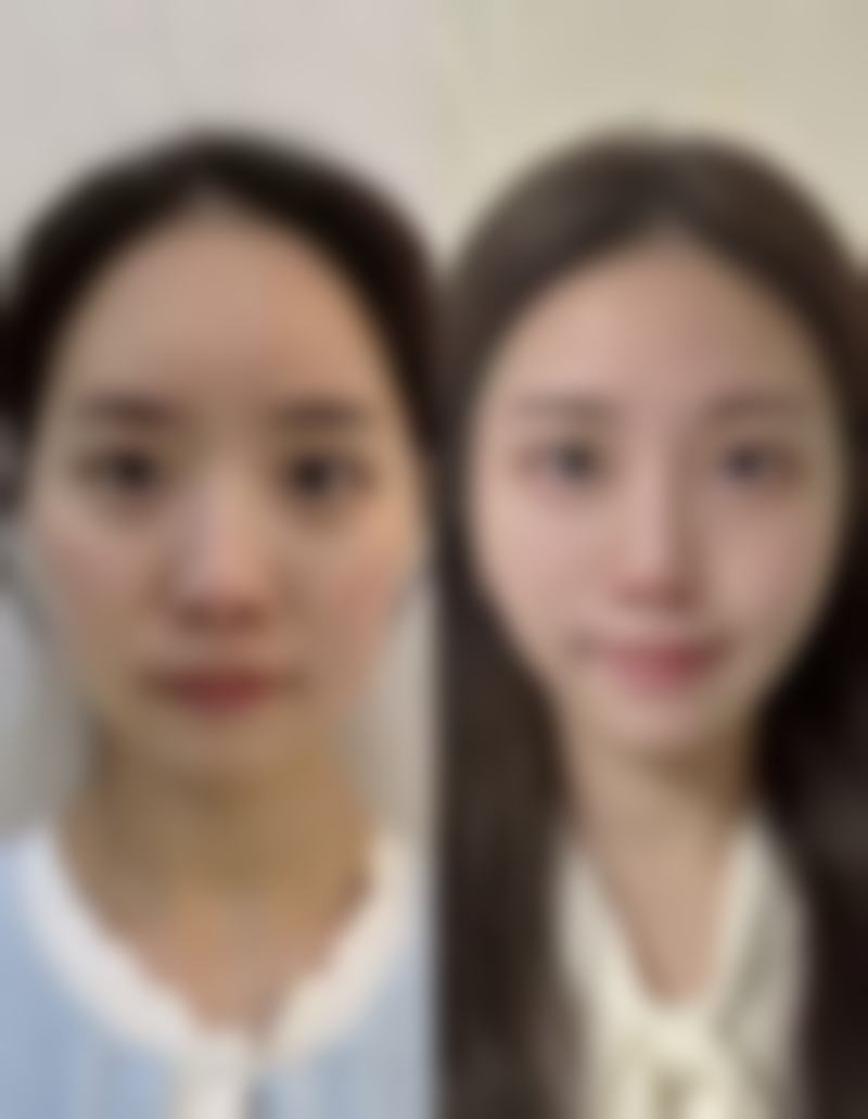 四、例假期打瘦脸针的健康风险