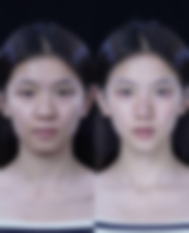 隆鼻手术多久可以吃辣椒和酱油？时间因人而异，这些因素很关键！ 