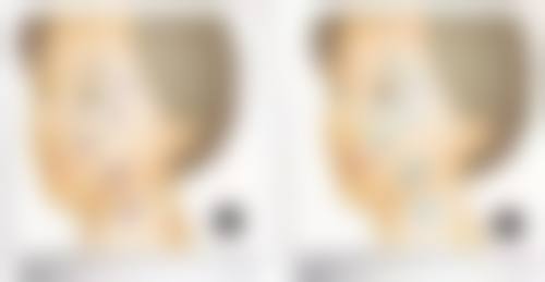 六、割双眼皮出血多吗?术后出血情况及护理