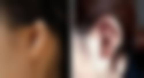 四、面部吸脂手术的风险和并发症