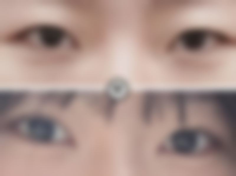 一、做双眼皮手术的基本介绍