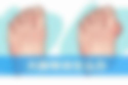 五、韩国白毒除皱之治疗说明