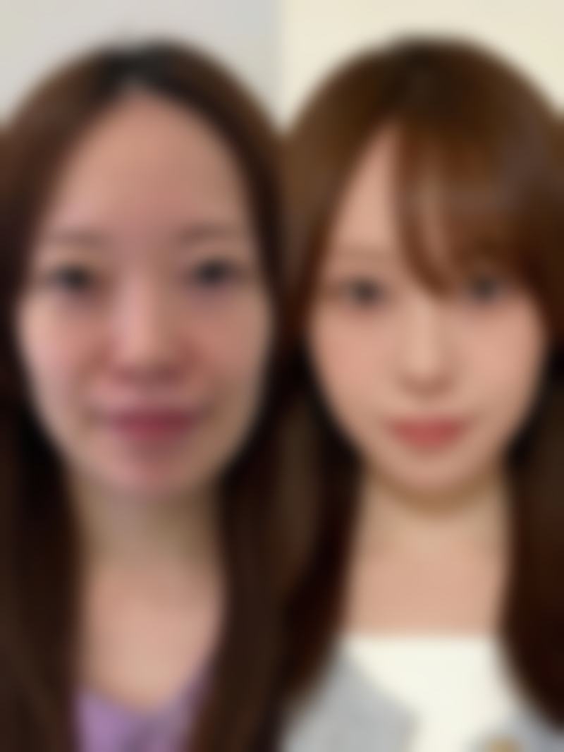 一、割双眼皮后饮食的重要性