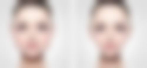 五、疤痕疙瘩体质的预防