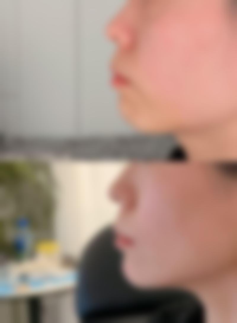 一、吸脂对身体的常见危害