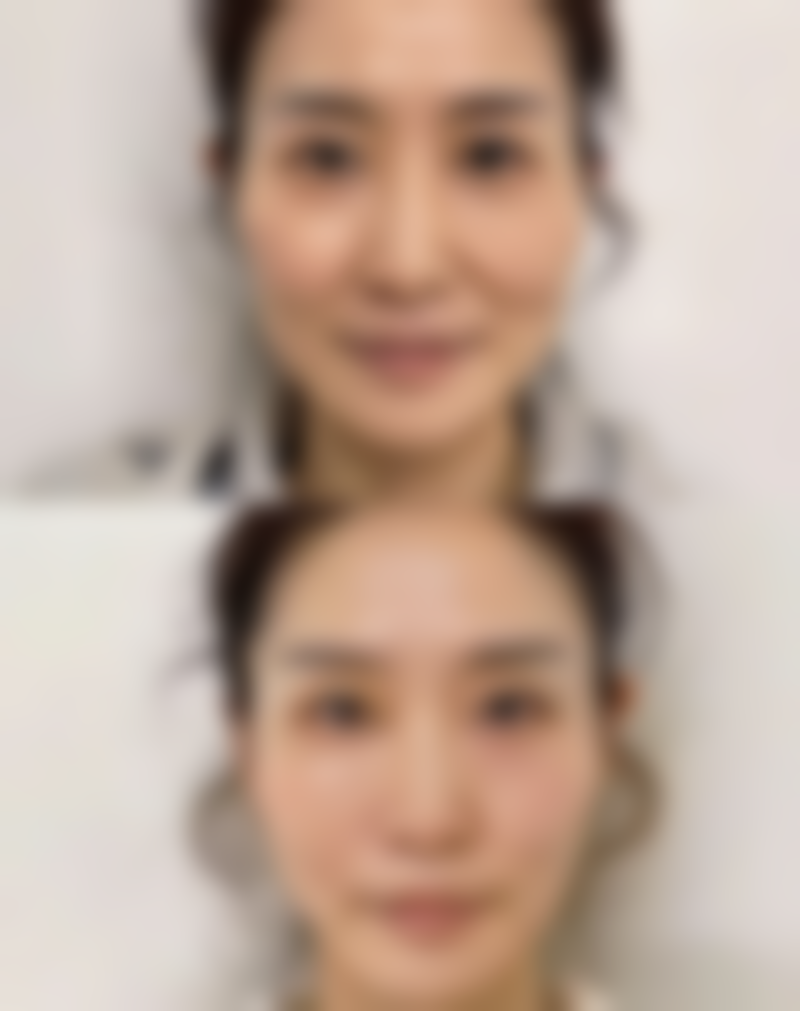 三、疤痕疙瘩体质的手术治疗