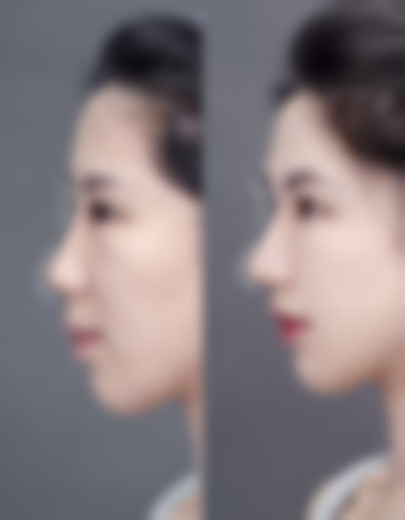 二、做了双眼皮眼睛痒的缓解方法
