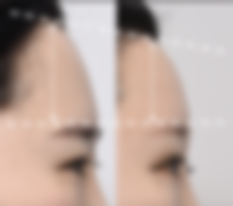 一、了解自体隆胸