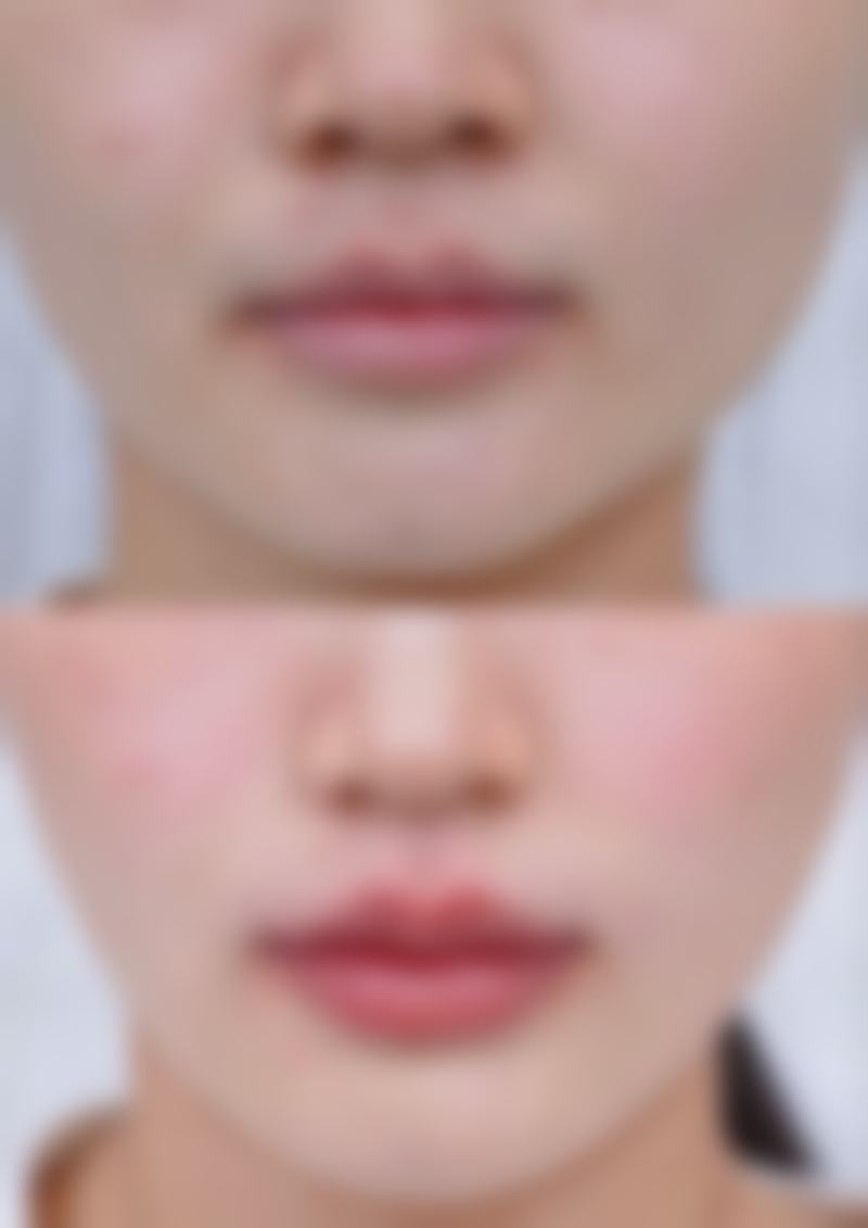 二、取隆胸假体后可能出现的并发症