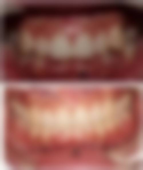 优惠活动详情:隐适美矫正原价48000元-优惠价38000元