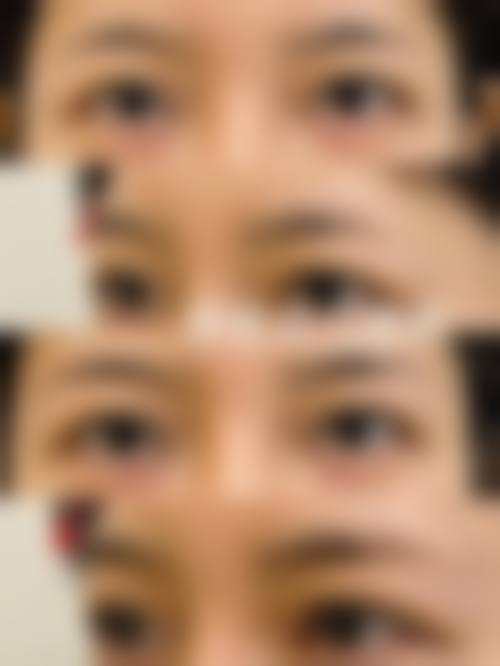 临床实例分享 张建亮 松原铭医整形美容医院 眼综合