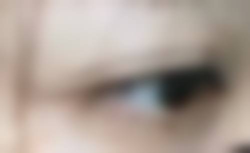 二、不适合割双眼皮的人群
