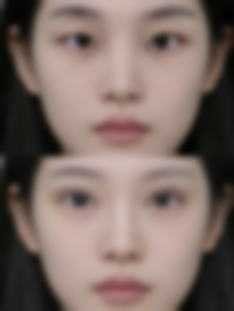 一、瘦脸针原理与脸凹成因
