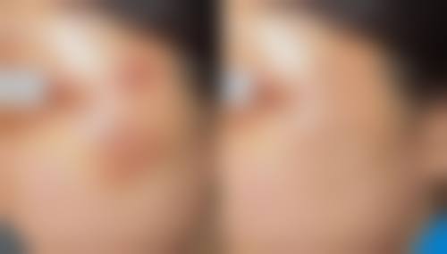 三、毛发种植时间受术式影响