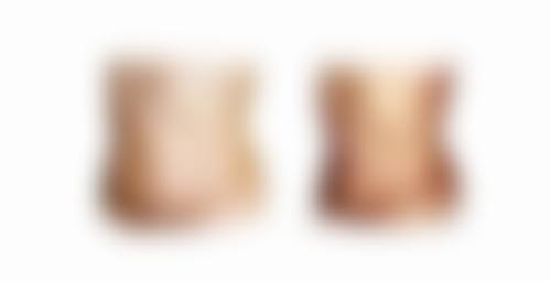 二、剖腹产疤痕增生的特点