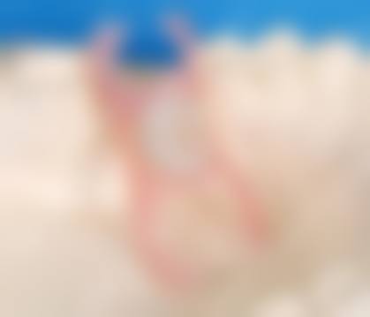 根管治疗
