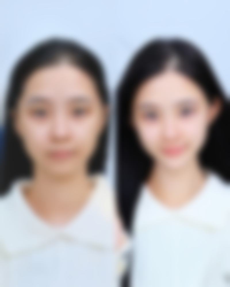 三、重度松弛的解决办法