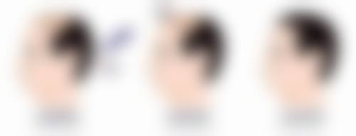 四、双眼皮手术的类型及适合人群