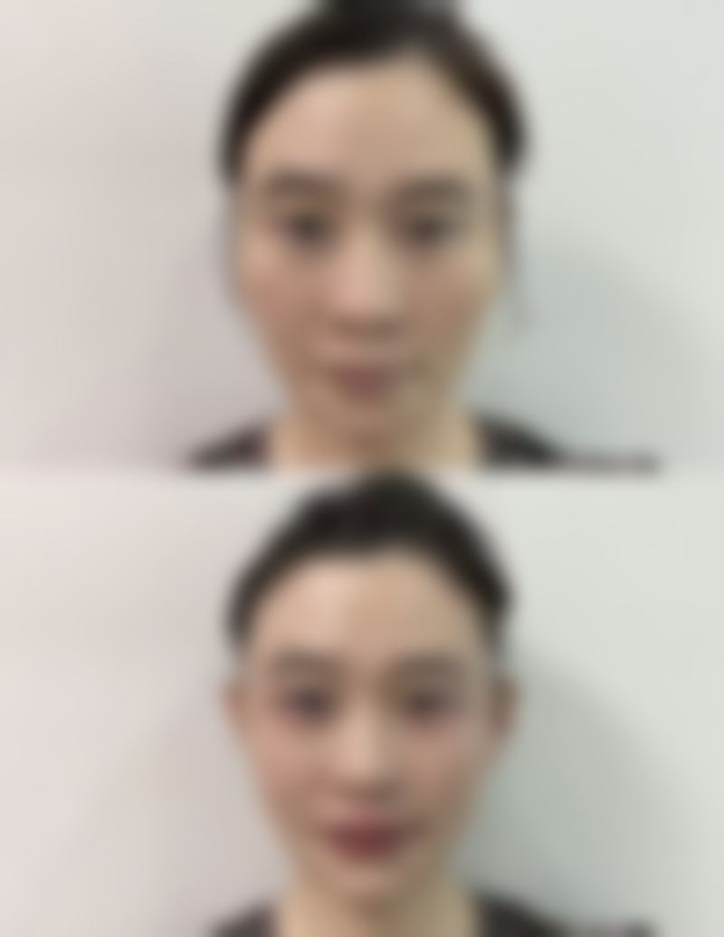 二、深入认识:烫伤后的头皮还能种植头发吗与烫伤程度的关系