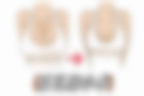 五、疤痕体质的人可以做埋线双眼皮吗：术后护理与应对方法