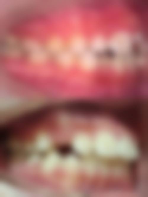 优惠活动详情——根管治疗限时优惠，诊疗更省心