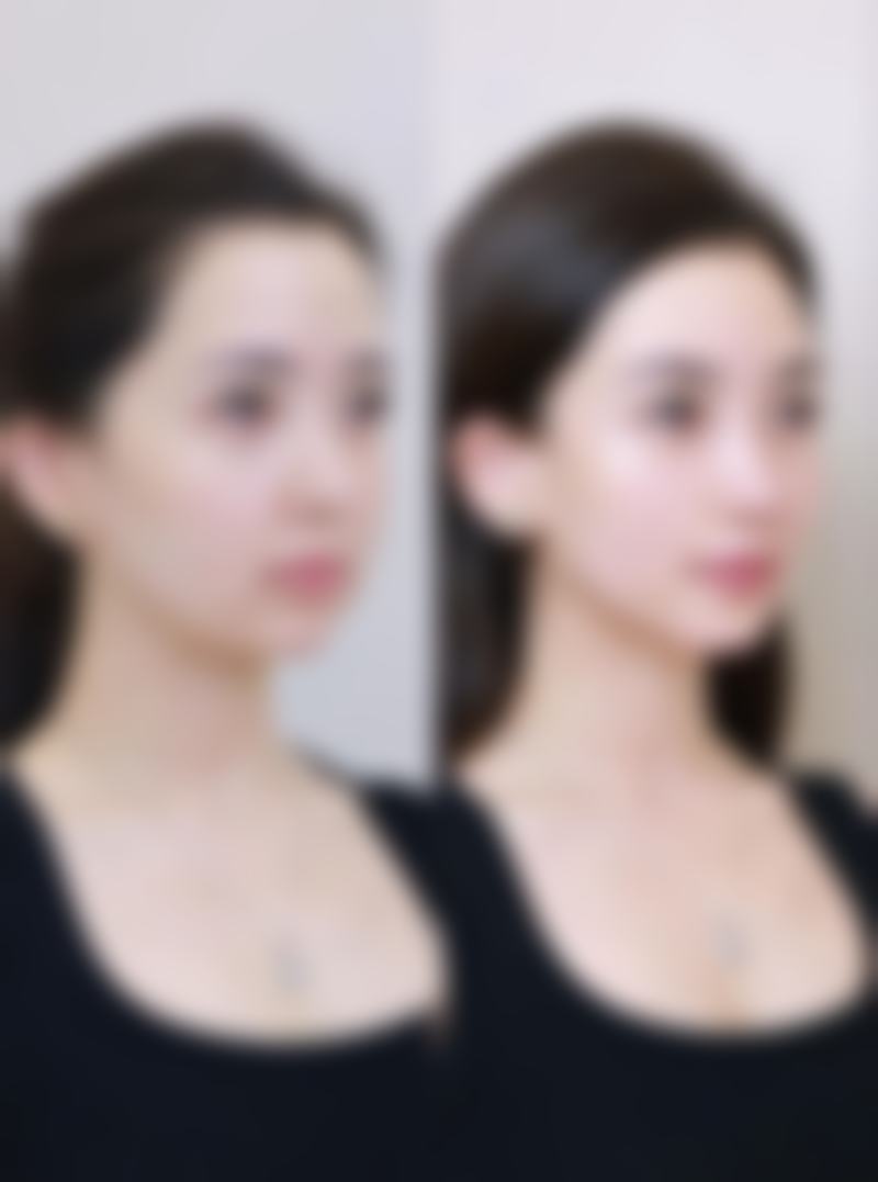 四、疤痕体质的人可以做埋线双眼皮吗：手术中的注意事项