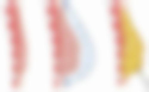 三、腿部抽脂后不同阶段的修复情况