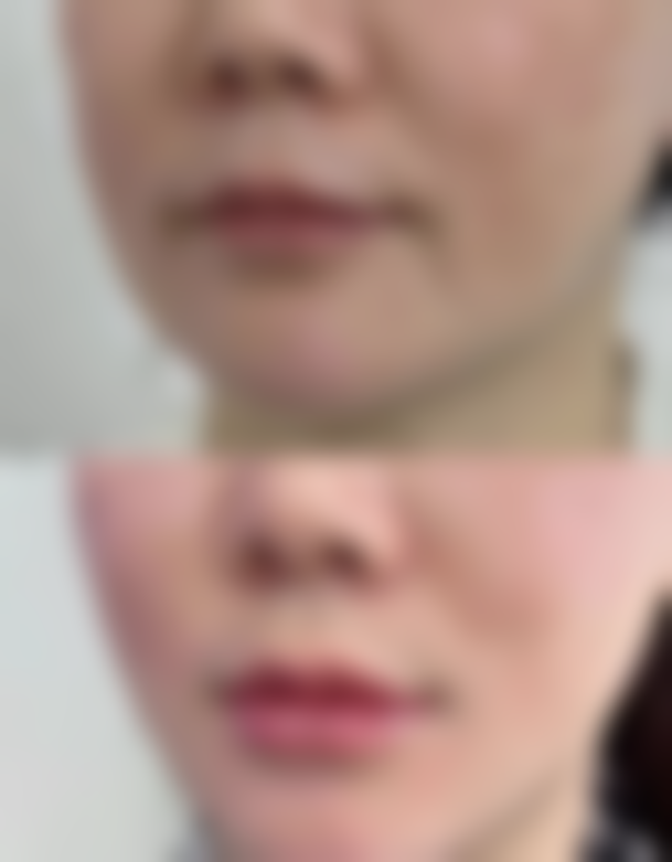 三、隆胸了可以喂奶吗?假体隆胸女性母乳喂养的注意事项