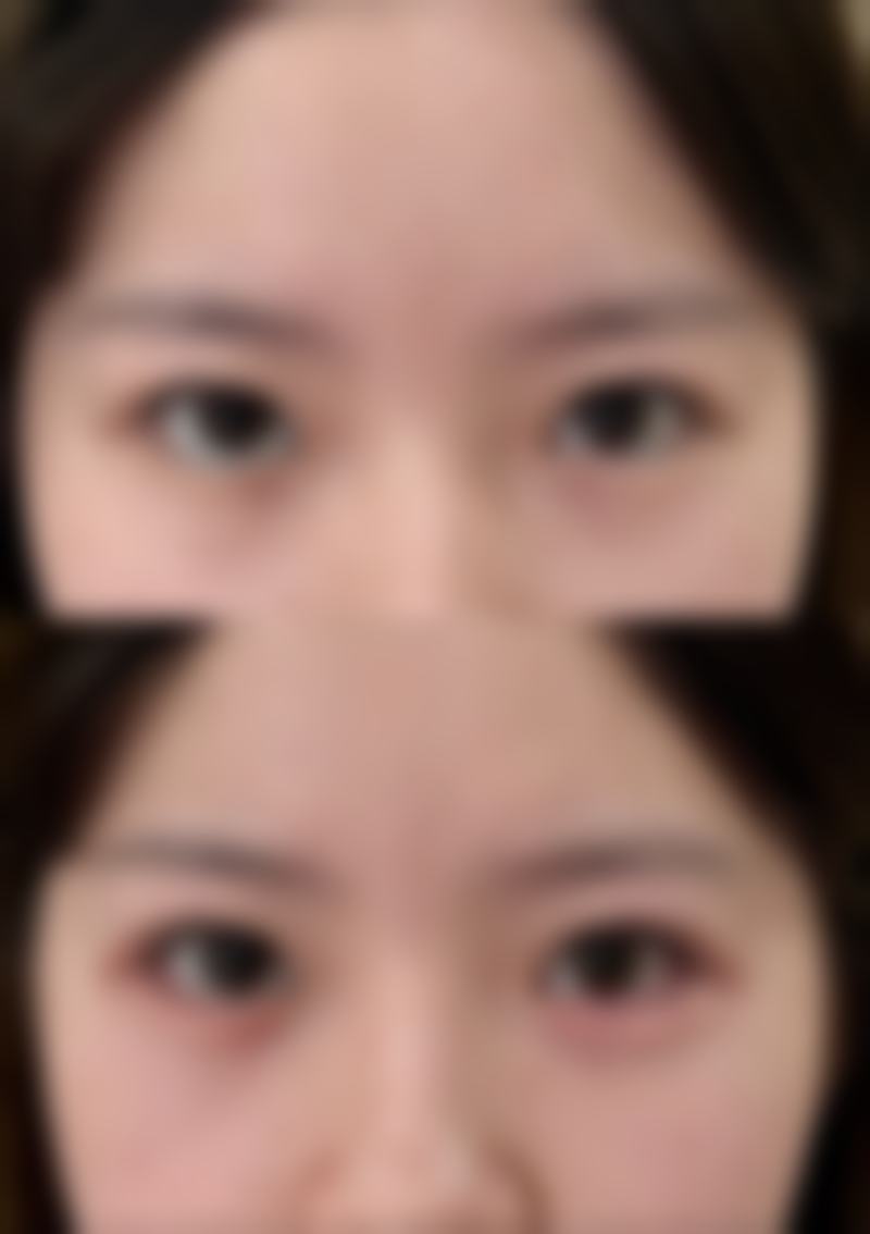 二、夏季做双眼皮眼皮修复修复情况