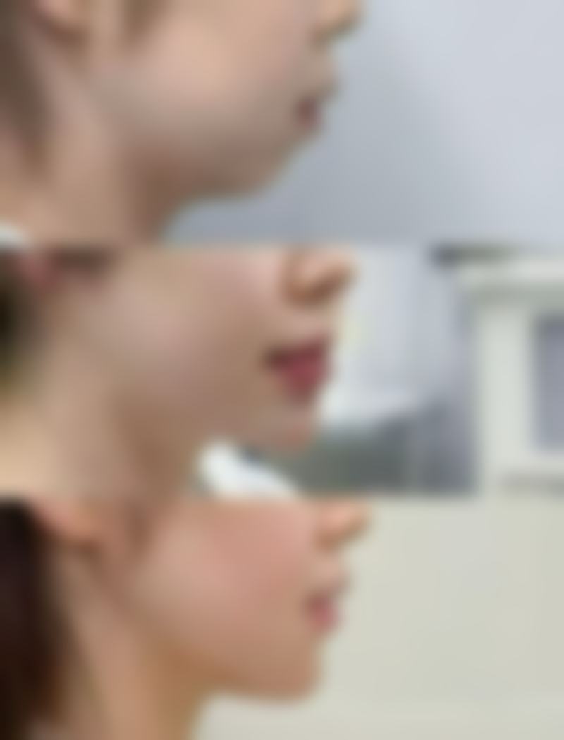 七、王香平去眼袋实例及优势