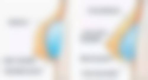 五、做过隆胸手术可以喂奶吗?医生怎么说